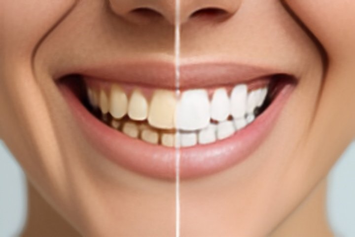 How Does Hydrogen Peroxide Whiten Teeth