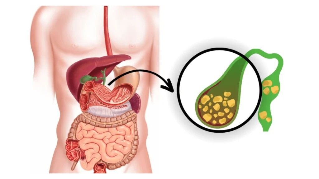 Cholerhiasis